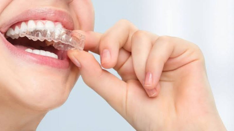 Clear Aligners in a Busy Family Routine